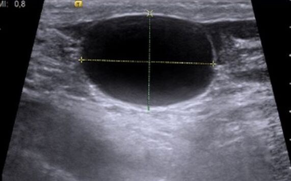 Cystonette helped cure chronic cystitis, my bladder is normal