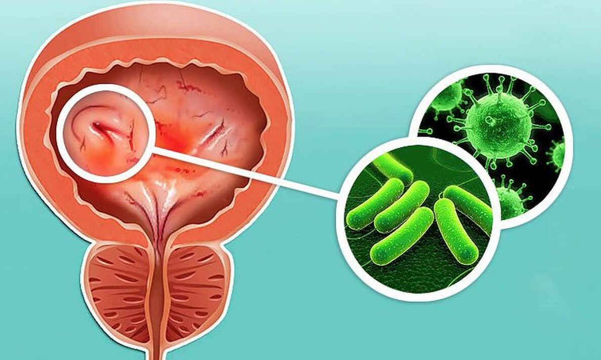 How cystitis develops